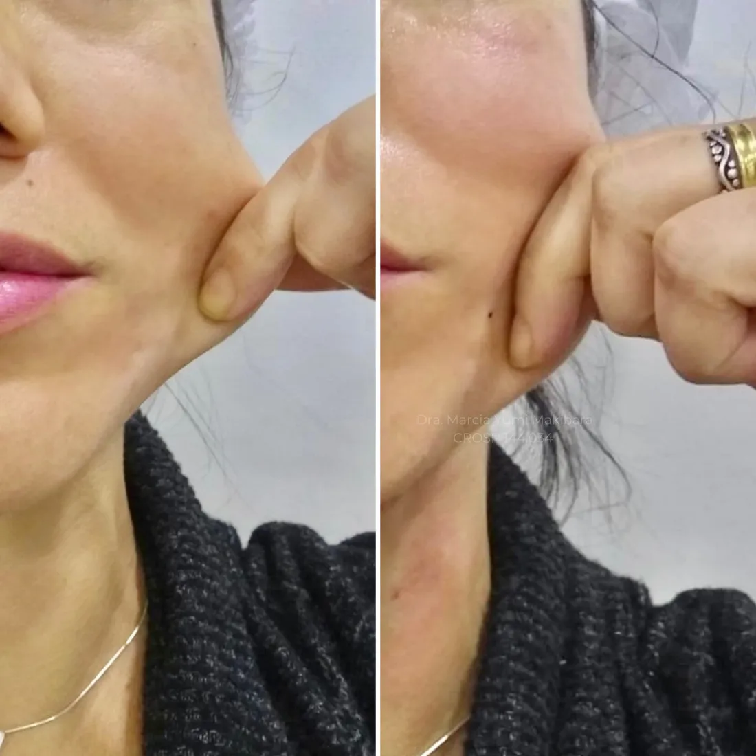 Resultado de bioestimulador de colágeno na HanaClinic, São José dos Campos