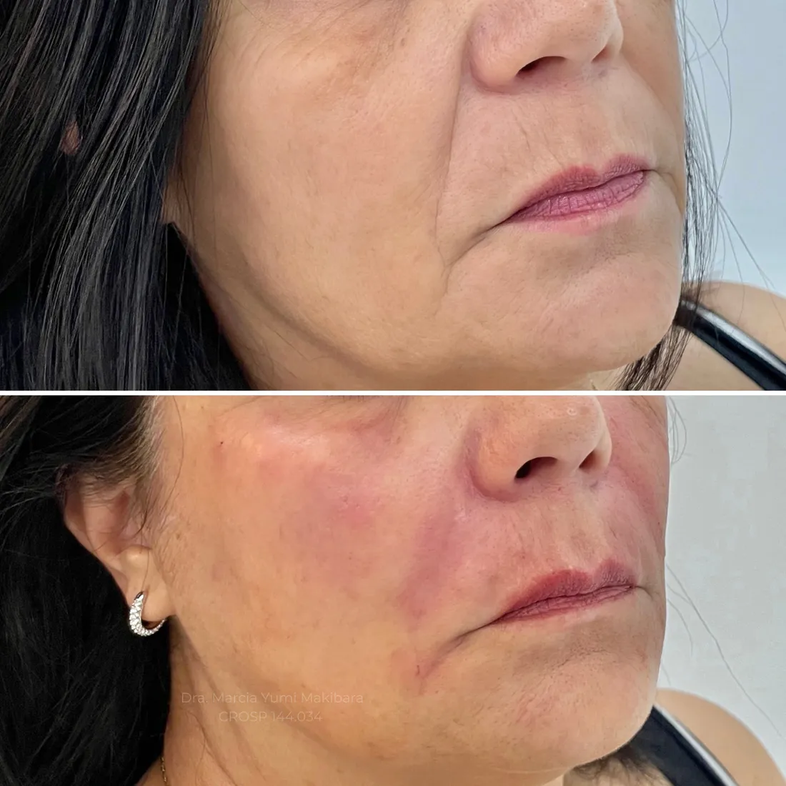 Resultado de preenchimento de malar (maçã do rosto) na HanaClinic, São José dos Campos