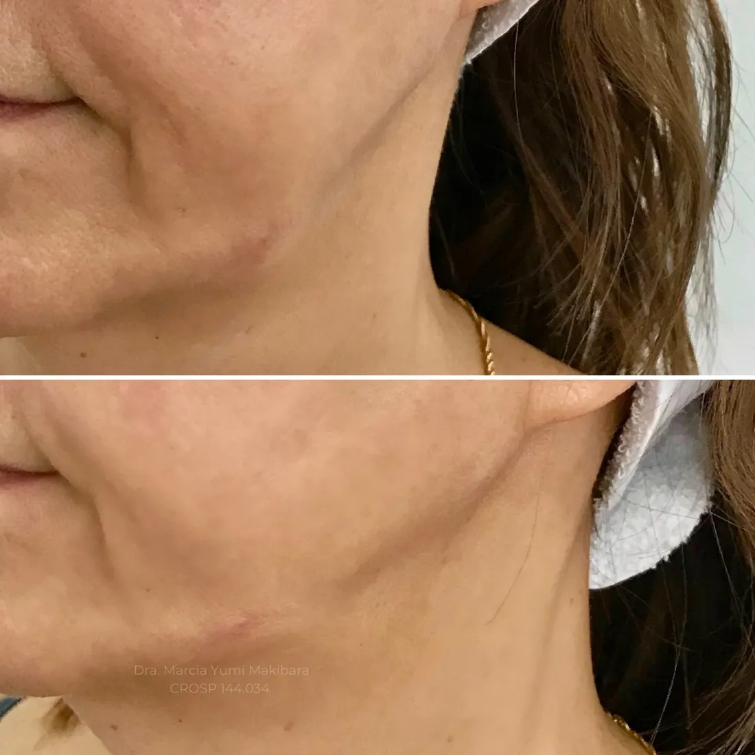 Resultado de preenchimento de mandíbula (contorno facial) na HanaClinic, São José dos Campos