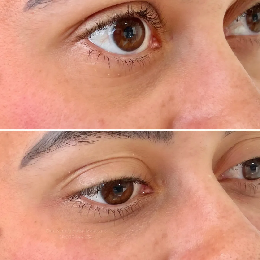 Resultado de preenchimento de olheiras com ácido hialurônico na HanaClinic, São José dos Campos
